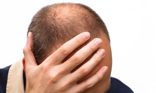 Hói đầu có nguy cơ ung thư tuyến tiền liệt cao hơn bình thường