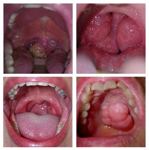 6 dấu hiệu nhận biết sớm bệnh ung thư vòm họng