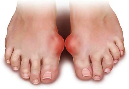 Nguyên nhân và triệu chứng của bệnh Gout