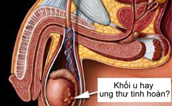 Ung thư tinh hoàn: biết sớm, chữa nhanh 