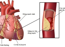 Tìm hiểu về xơ vữa động mạch