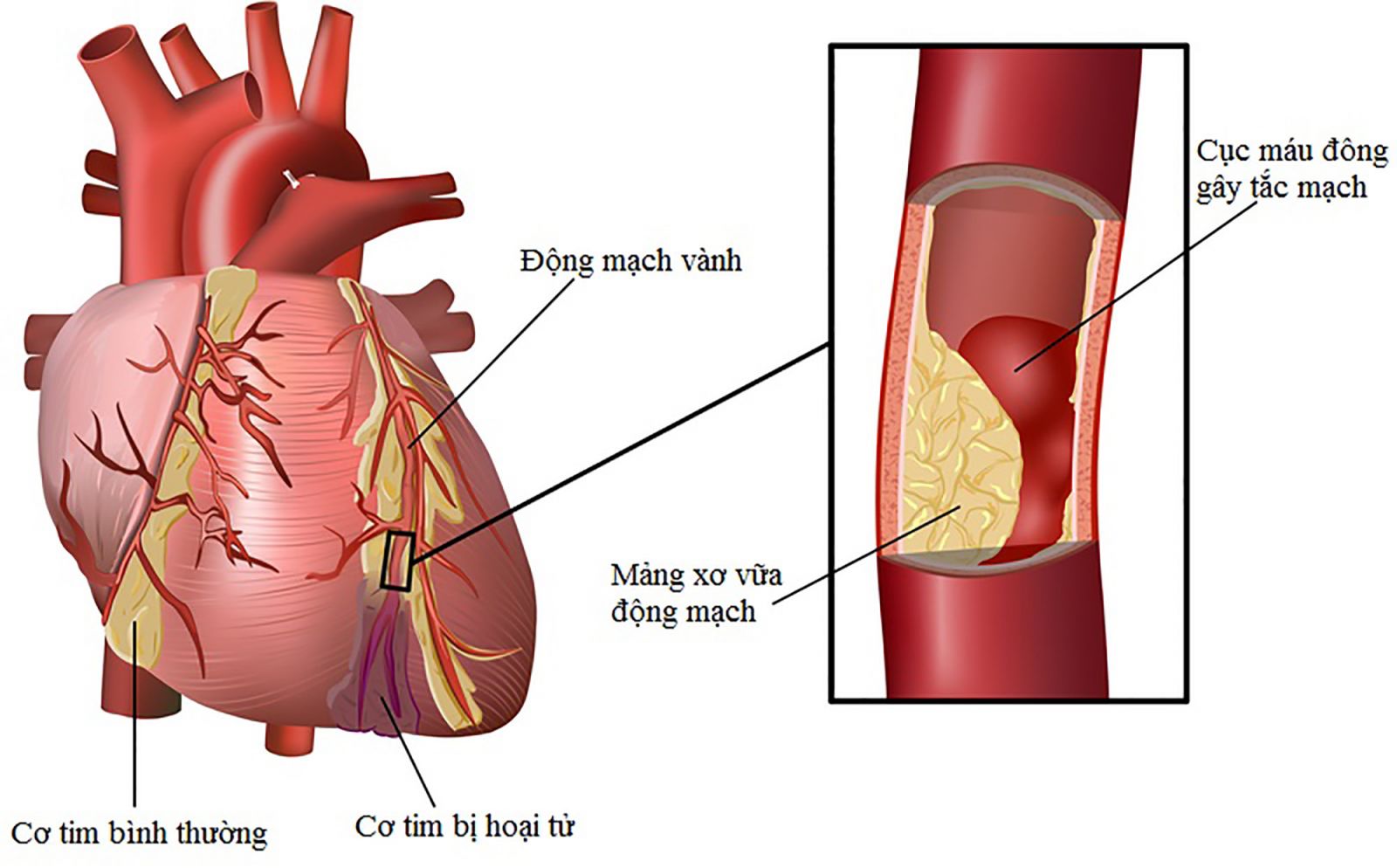 Tìm hiểu về xơ vữa động mạch