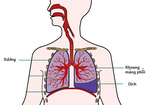 Những nguyên nhân gây ra tràn dịch màng phổi