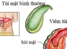 Tìm hiểu về bệnh viêm túi mật