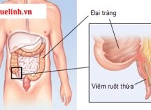 Bệnh viêm ruột thừa nguy hiểm như thế nào?