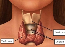 Suy giáp nguy hiểm khó lường