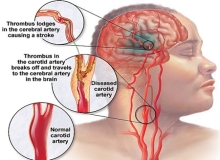 Hiểu về rối loạn tiền đình