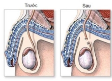 Thắt ống dẫn tinh làm tăng nguy cơ ung thư tuyến tiền liệt