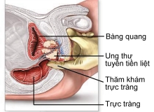 5 điều nên biết về ung thư tuyến tiền liệt