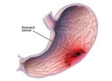 Những điều cần biết về ung thư dạ dày