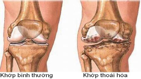 thoái hóa khớp