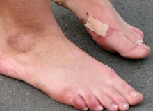 Biểu hiện của Gout