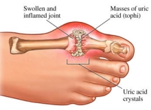 Gout hay viêm khớp?