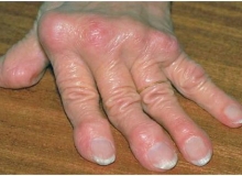 Triệu chứng của Gout mạn tính