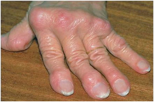 Triệu chứng của Gout mạn tính