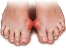 Nguyên nhân và triệu chứng của bệnh Gout