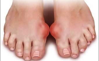 Nguyên nhân và triệu chứng của bệnh Gout