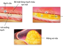 Tại sao huyết áp cao lại dẫn đến đột quỵ hoặc tử vong?