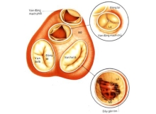 Tổng hợp các vấn đề của van tim