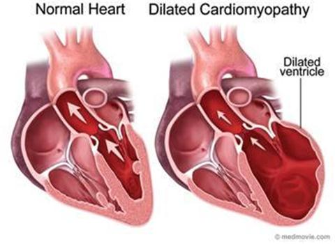 Những điều cần biết về viêm cơ tim
