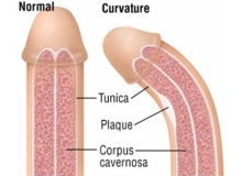 Dương vật bị cong do đâu?